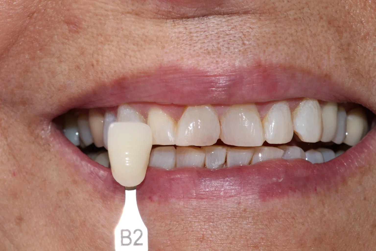 Antes de blanqueamiento dental en Miraflores
