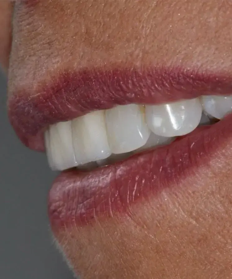 Caso de éxito estética dental Dra Alejandra Ulloa 4