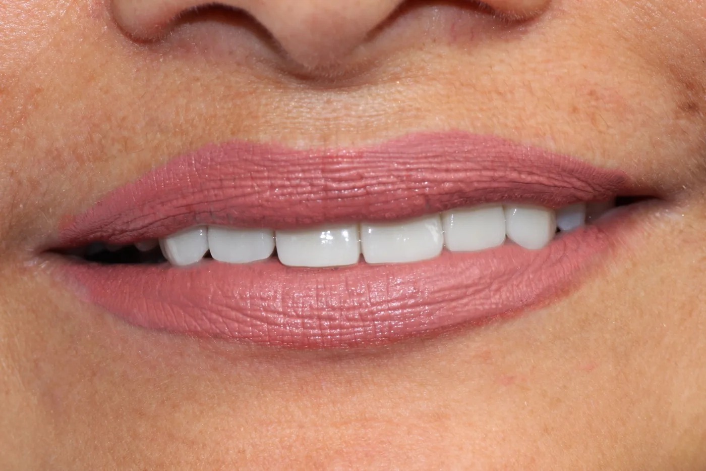Caso de éxito de estética dental en Miraflores 1