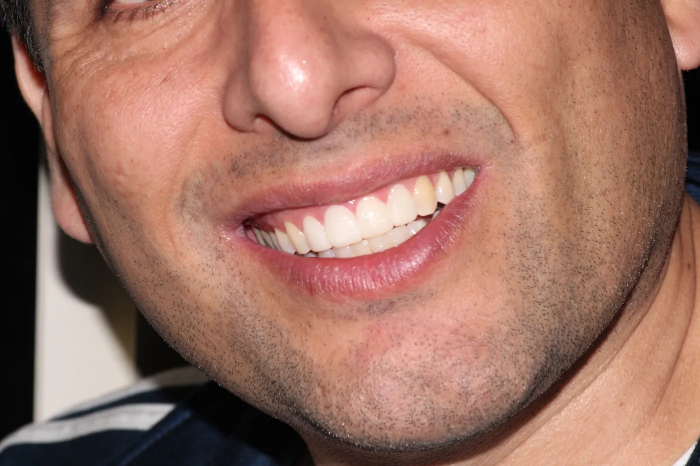 Caso de éxito de estética dental en Miraflores 2