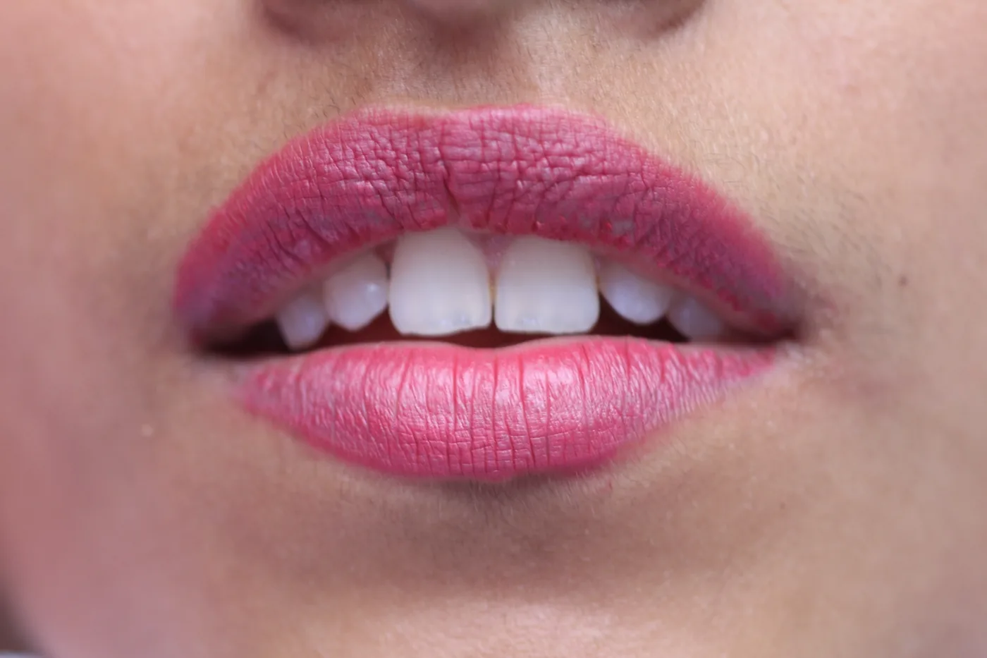 Caso de éxito de estética dental en Miraflores 5