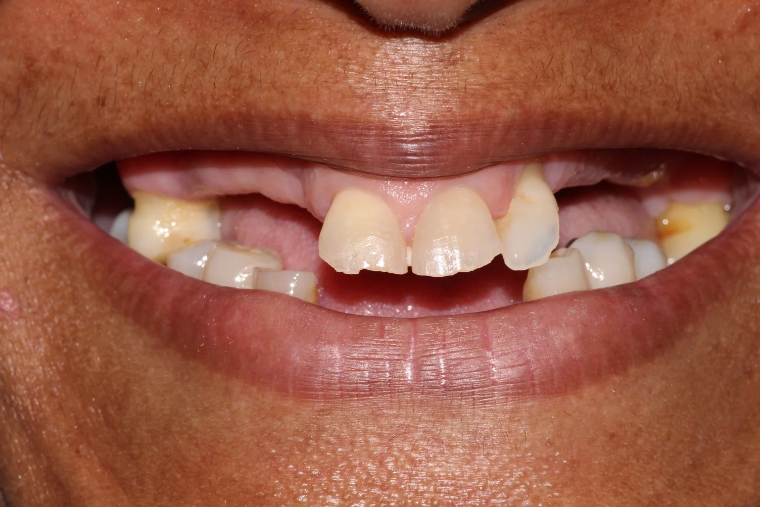 Después de prótesis dentales en Miraflores